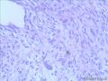 乳腺梭形细胞肿瘤图11