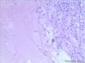乳腺梭形细胞肿瘤图7