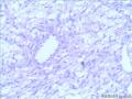 乳腺梭形细胞肿瘤图4