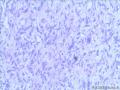 乳腺梭形细胞肿瘤图8