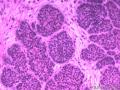 基底细胞癌图6