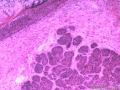 基底细胞癌图2