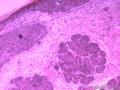 基底细胞癌图1