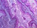 龟头高分化鳞状细胞癌图4