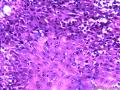 龟头高分化鳞状细胞癌图11