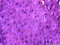龟头高分化鳞状细胞癌图9