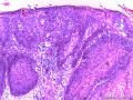 龟头高分化鳞状细胞癌图5