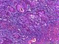 龟头高分化鳞状细胞癌图7