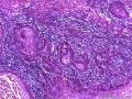 龟头高分化鳞状细胞癌图6