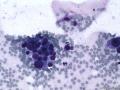 典型图片之（16）：FNA（乳腺癌）3图4