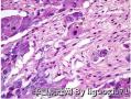学习 复合性嗜铬细胞瘤图4