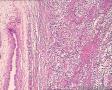 睾丸肿块——是传说中的精原细胞瘤吗？请老师们看看图3
