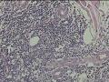 臀部肿物，皮下组织间隙成团淋巴细胞聚集图11