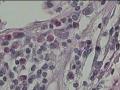 臀部肿物，皮下组织间隙成团淋巴细胞聚集图17