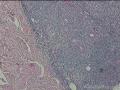 臀部肿物，皮下组织间隙成团淋巴细胞聚集图6