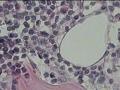 臀部肿物，皮下组织间隙成团淋巴细胞聚集图16