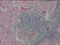 臀部肿物，皮下组织间隙成团淋巴细胞聚集图8