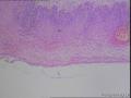 宫颈活检，遇到这种挖空细胞不典型，但HPV16阳性的，大家怎么报告？需要提示吗？图6