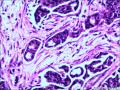 穿刺病例阅片：乳腺浸润性导管癌图8