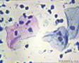 宫颈分泌物  有精子？上皮细胞有病变没有？图15