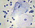 宫颈分泌物  有精子？上皮细胞有病变没有？图13