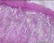 左侧外耳道肿块：神经鞘瘤？纤维粘液瘤？图12