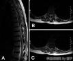 恶性软骨瘤样汗管瘤转移致脊髓压迫（病例报道）-转帖图1