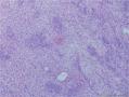 睾丸肿物：性索-间质肿瘤？不成熟畸胎瘤？或者？？？图9