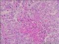 子宫内膜癌图6