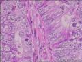 子宫内膜癌图5