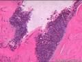 请教！乳腺结节性腺病伴纤维腺瘤形成。图17