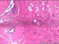 请教！乳腺结节性腺病伴纤维腺瘤形成。图2