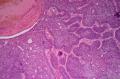 基底细胞癌OR毛母细胞瘤？图12