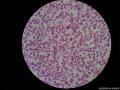 细胞常规切片+免疫组化图5