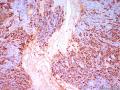乳腺肿物，SMA阳性，可以诊断化生性癌吗？图11