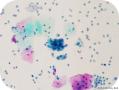 宫颈液基---15346（图片多点）上传活检及免疫组化结果！图34