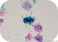 宫颈液基---15346（图片多点）上传活检及免疫组化结果！图40