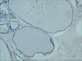 考虑乳腺增生症，但一些导管上皮像是单层的，请各位老师看一下，谢谢图6