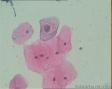 宫颈细胞图11