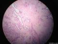 乳腺肿物，仅仅是管周型纤维腺瘤吗图1