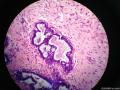 乳腺肿物，仅仅是管周型纤维腺瘤吗图3