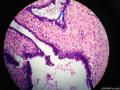 乳腺肿物，仅仅是管周型纤维腺瘤吗图4