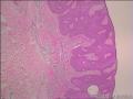 基底细胞瘤还是脂溢性角化病图4