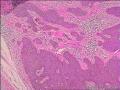 基底细胞瘤还是脂溢性角化病图14
