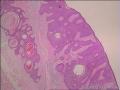 基底细胞瘤还是脂溢性角化病图3