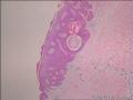 基底细胞瘤还是脂溢性角化病图19