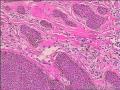 基底细胞瘤还是脂溢性角化病图15