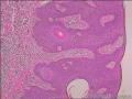 基底细胞瘤还是脂溢性角化病图7