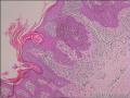 基底细胞瘤还是脂溢性角化病图12