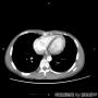 年轻男性，双肺多发结节图1